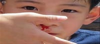 Kids with hemophilia can bleed easily...